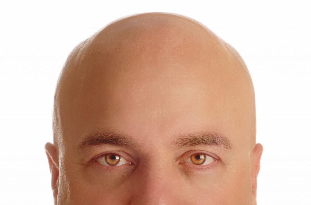 Calvitie : définition et signes visibles