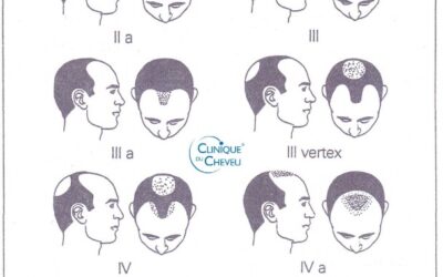 Les différentes phases de la calvitie chez l’homme