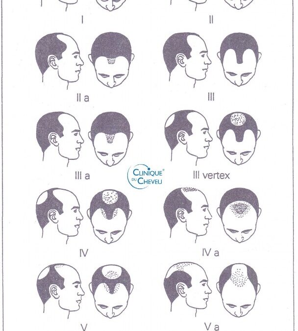 La chute de cheveux