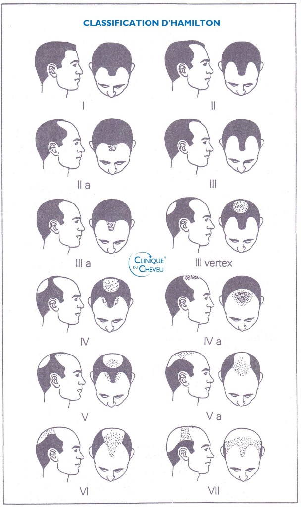 Les différentes phases de la calvitie chez l'homme | Clinique du ...