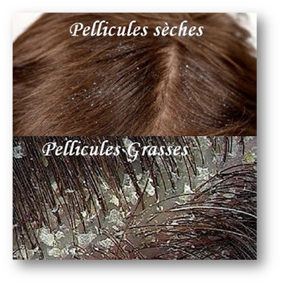 Traitement pellicules Clinique du Cheveu