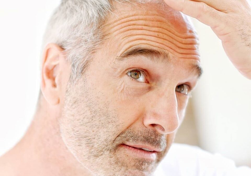 ALOPECIE et CALVITIE